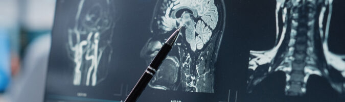 doctor pointing injury seen in x-ray of brain scan